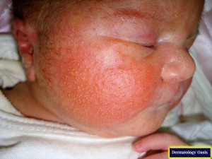Erythema Toxicum Neonatorum