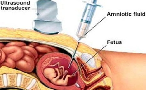 Amniyosentez Nedir?