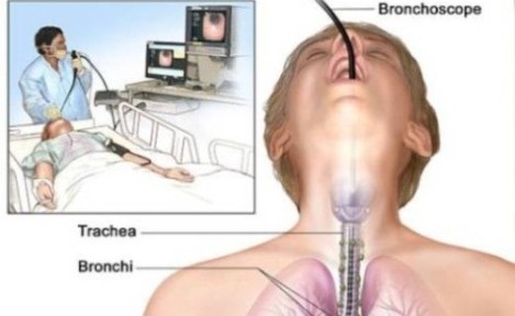 Çocuklarda Bronkoskopi Nasıl Uygulanır?