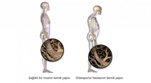 Kemik Erimesinden Korunmak İçin Ne Yapmalı?