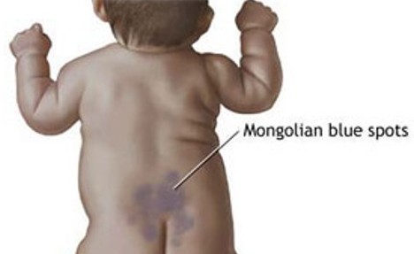 Bebeklerde Görülen Mongol Lekeleri
