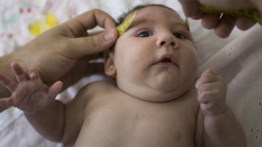 Zika Bebeklerde Eklem Hasarına da Yol Açıyor